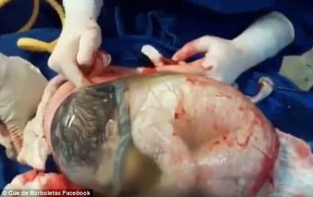 This baby was born still inside the amniotic sac (video)