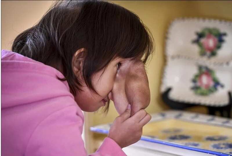 Pinay girl with deformed face gets life-changing surgery