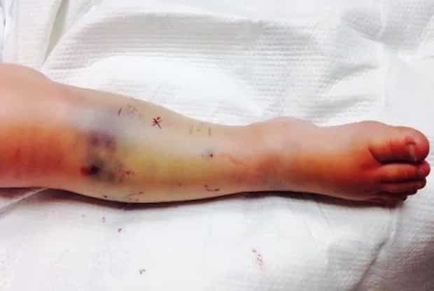 North Carolina girl bitten by dangerous creature