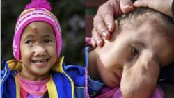 Salamat may surgery! Pinay girl with "monster" face gets life-changing surgery in Australia