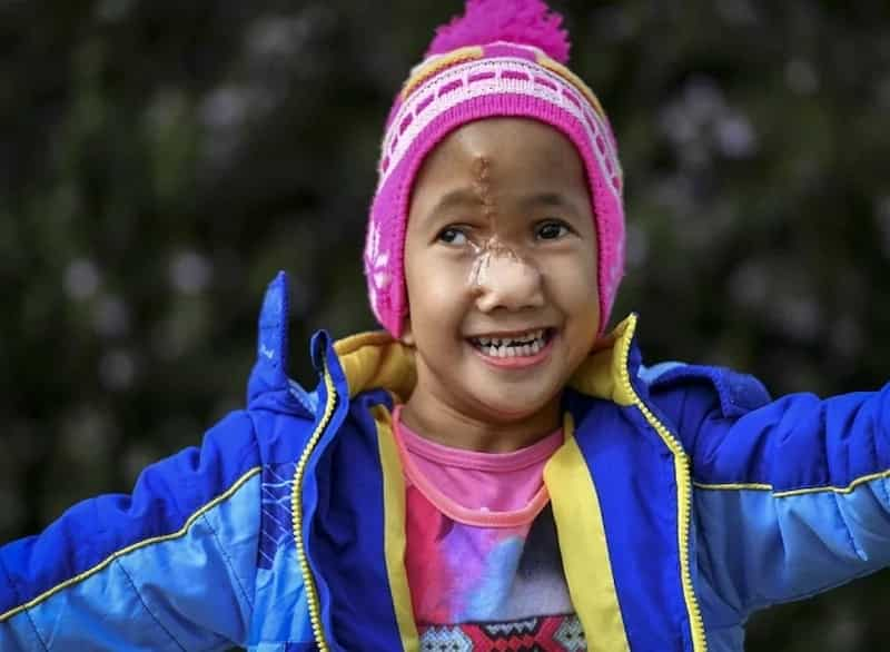 Pinay girl with deformed face gets life-changing surgery