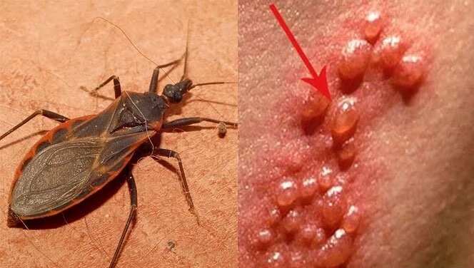 Kissing bugs infecting Filipinos with deadly Chagas disease