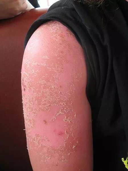 Watch out for this six summer diseases