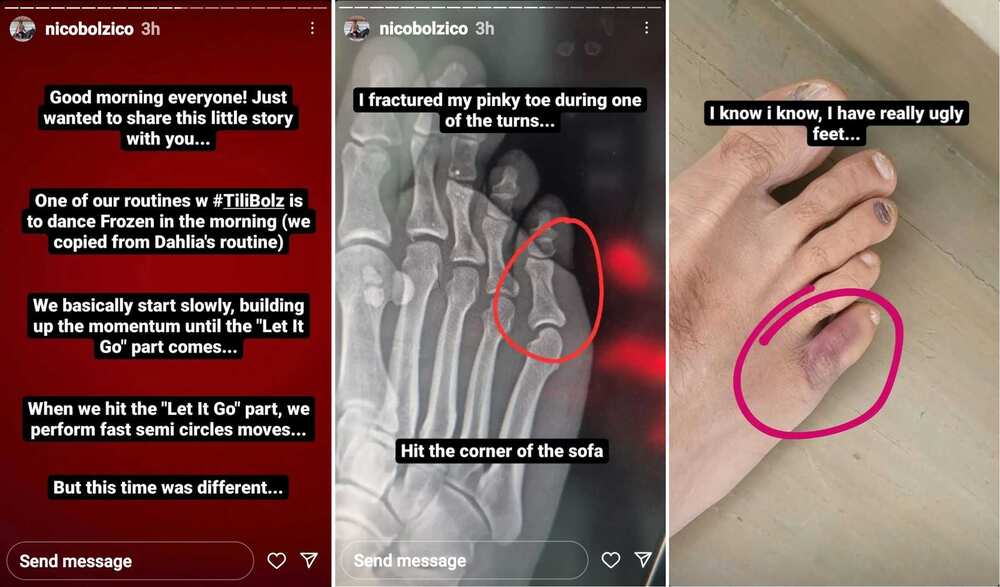 Nico Bolzico, na-fracture ang pinky toe habang sumasayaw kasama si baby Thylane