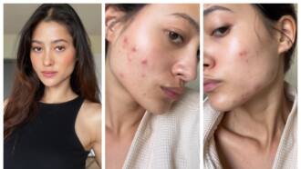 Maureen Wroblewitz bravely opens up about her acne breakouts