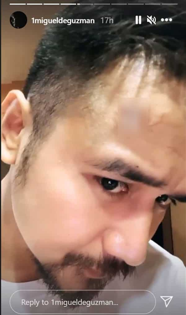 JM De Guzman suffers head injury during taping, "Init Sa Magdamag"