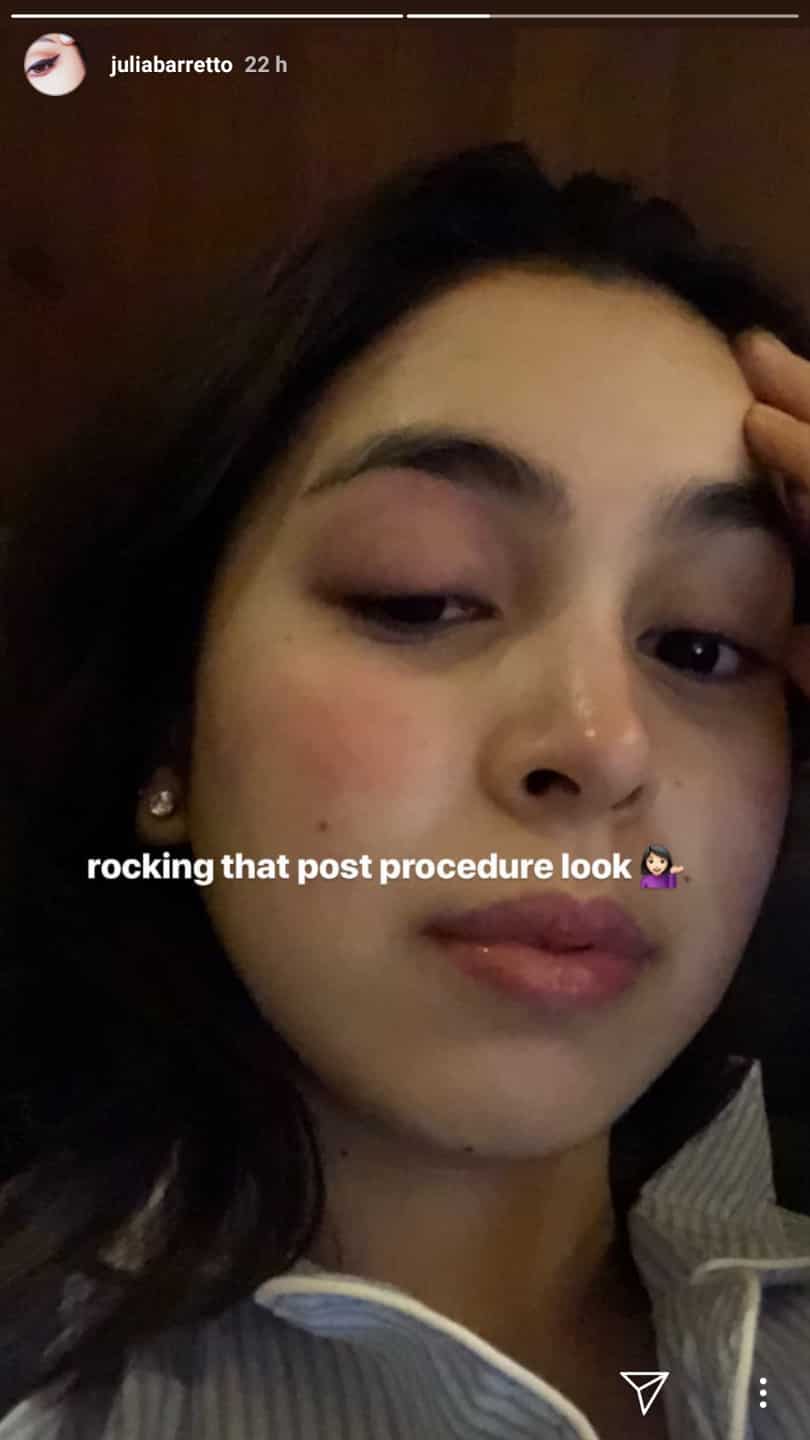 Julia Barretto posts post eye operation photos
